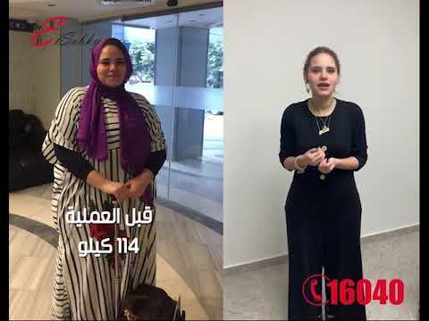 تجربتي مع التكميم , ابسط طرق لخسارة الوزن الزائد