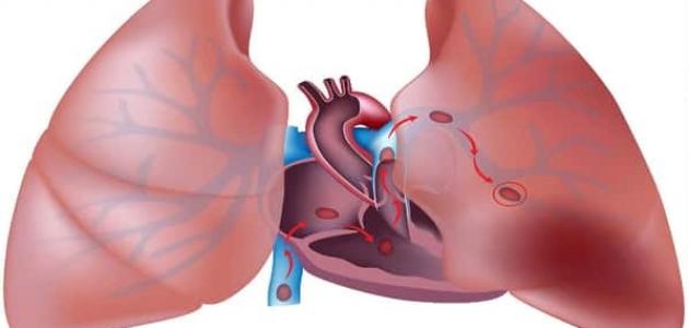 معلومات عن انسداد الشريان الرئوي , نبذه عن جلطه الرئه